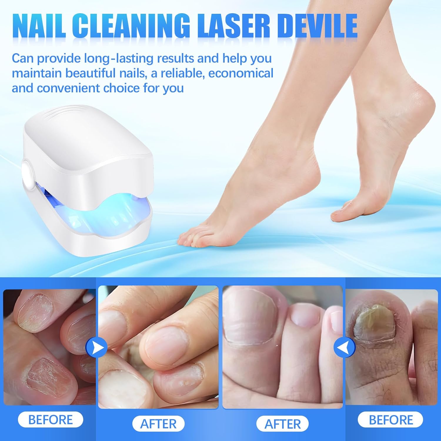 Rechargeable Nail Fungus Laser – Anti-Fungal Device for Toenails, Hands & Feet (Home Use)